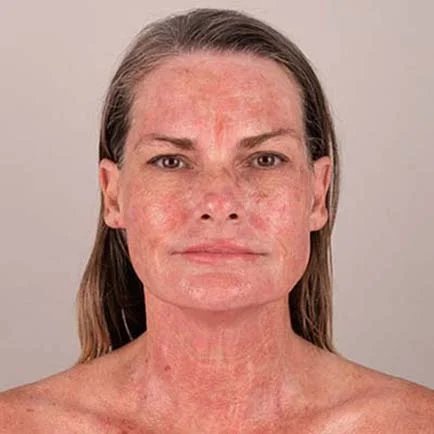 Skin rejuvenation microneedling Morpheus8 Austin